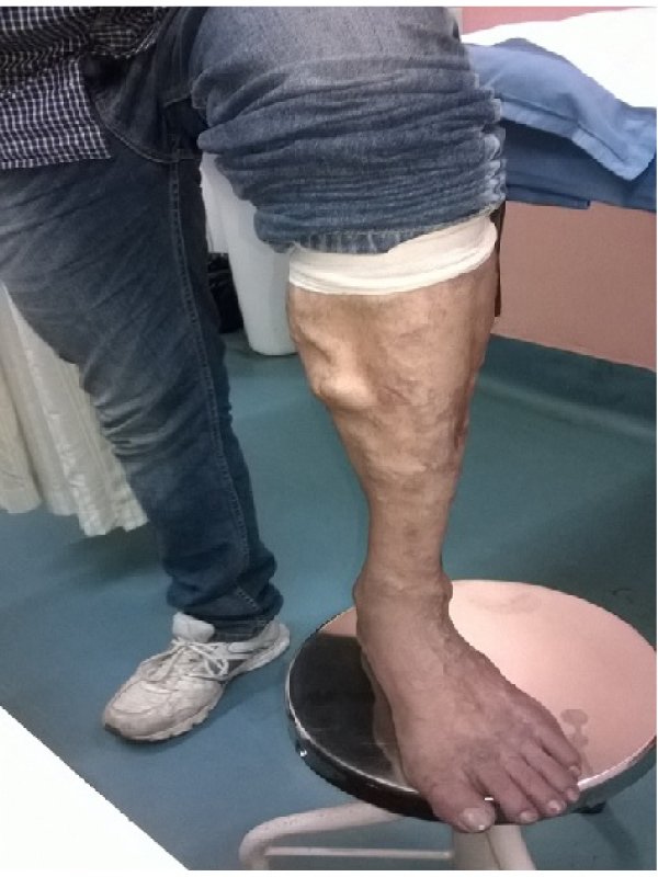 Varicose Veins
