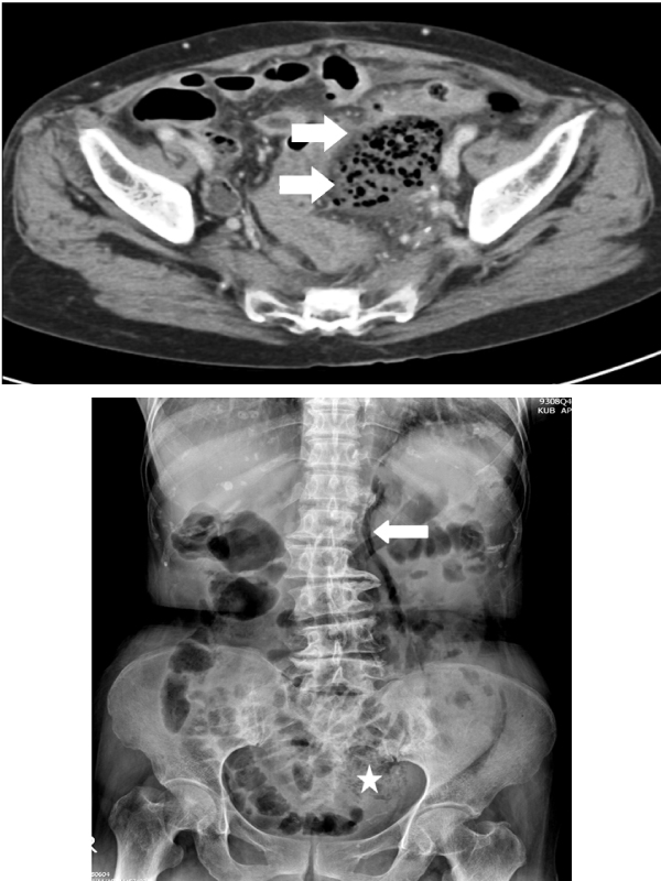 Concomitant Emphysematous Pyelonephritis and Ureteritis