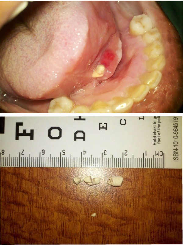 Sialolithiasis