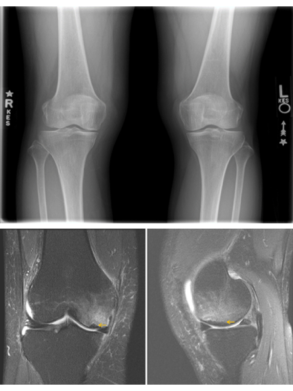 Spontaneous Osteonecrosis as a Cause of Knee Pain in an Older Active Woman