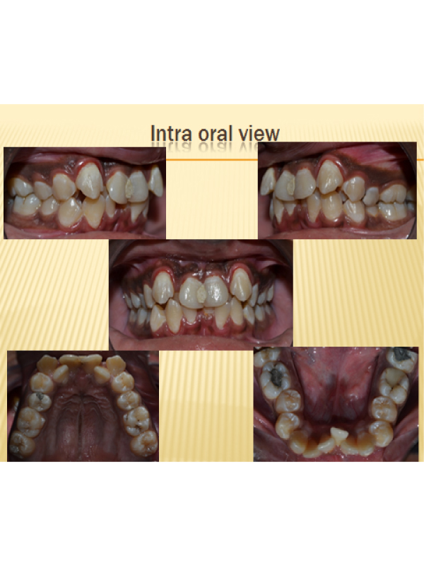 Sever Crowding with Total Palatal Displace Permanent Lateral Incisors