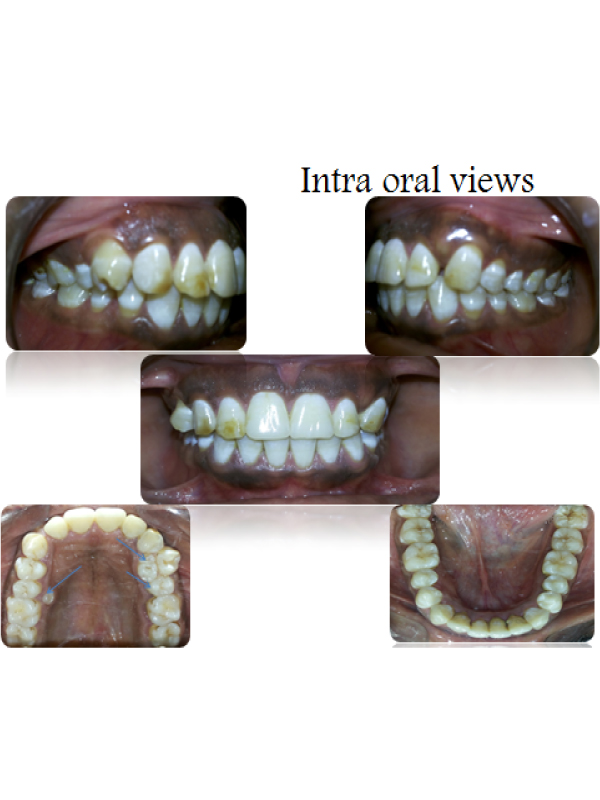 Dental Fluorosis with Numerous Erupted and Un-Erupted Supernummary Teeth in Maxilla and Mandible
