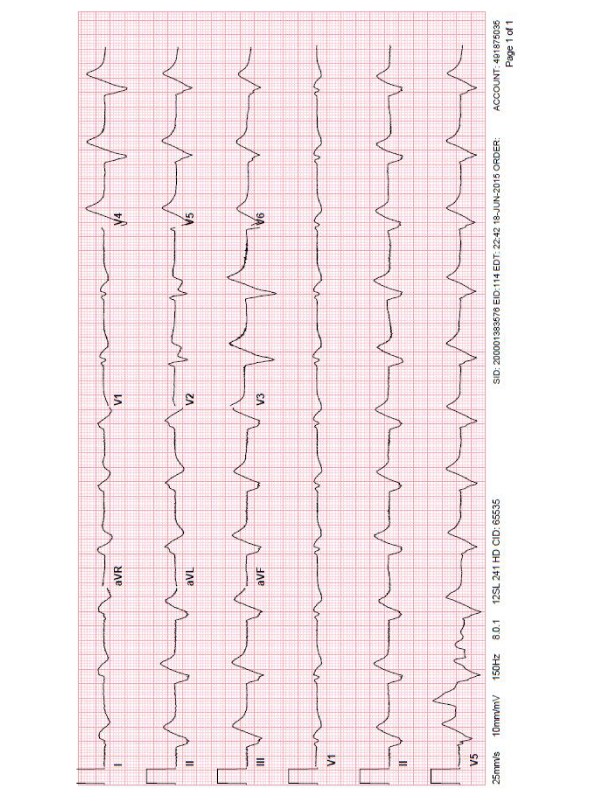 EKG Changes in Severe Hyperkalemia in Digoxin Toxicity