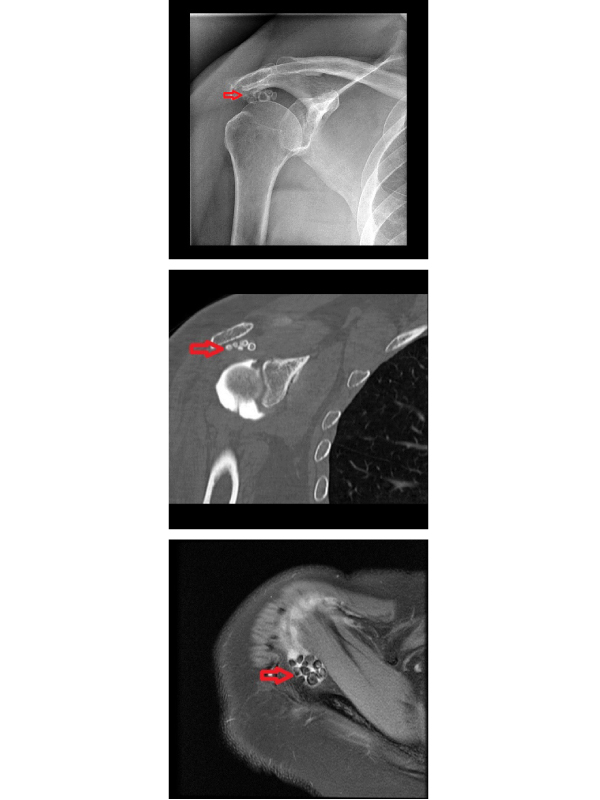 Synovial Osteochondromatosis of Shoulder