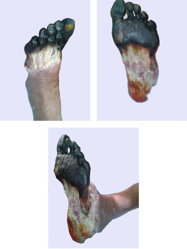 Wagner Grade 5 Diabetic Foot Ulcer