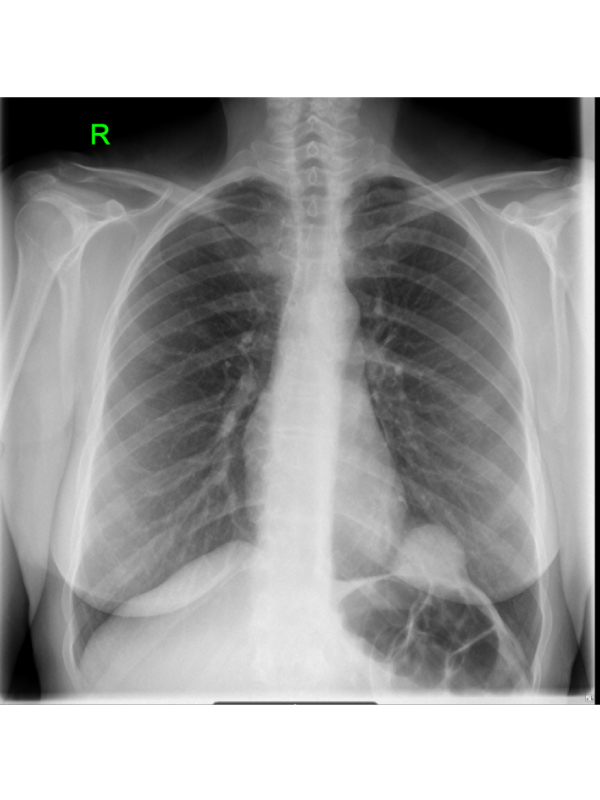 A Dome on the Dome of the Hemidiaphragm