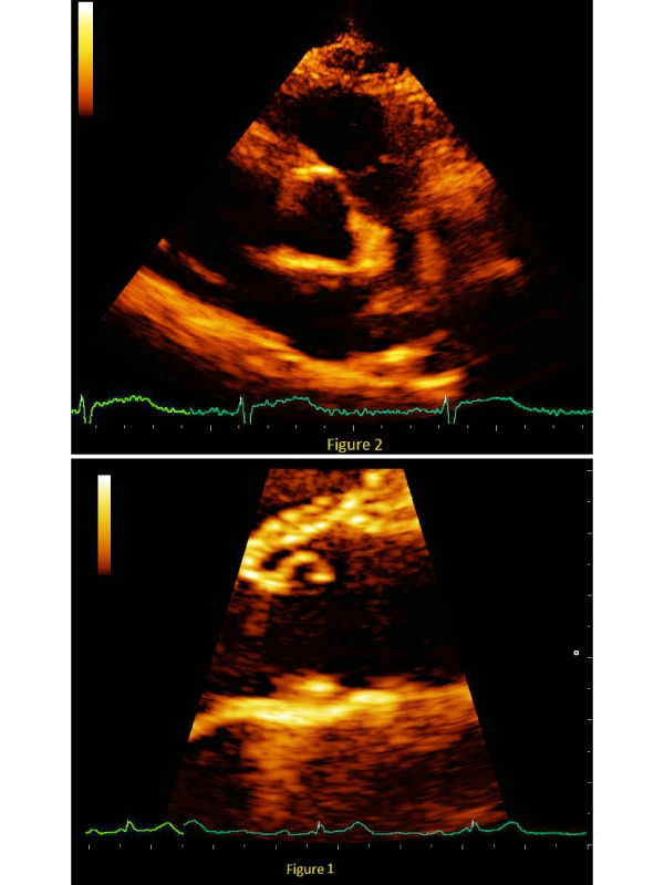 Echocardiographic Findings of Congenital Valvular Heart Disease in Young Athletes