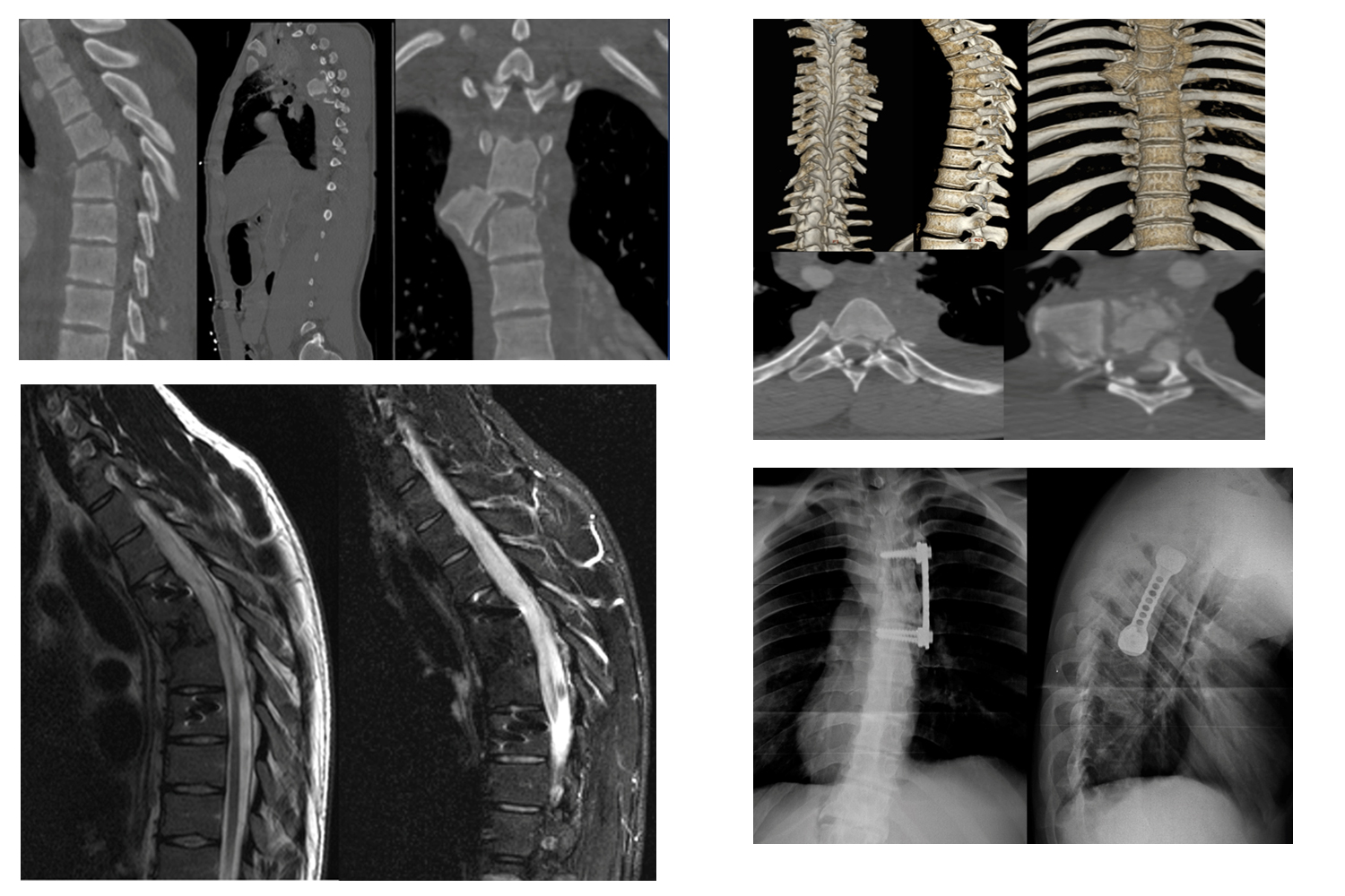 Atypical Fracture Dislocation of Thoracic Vertebra in a Young Men