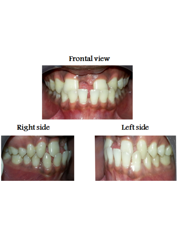 Upper Mid Line Diastema with Bilateral Congenitally Missing Upper Lateral Incisors