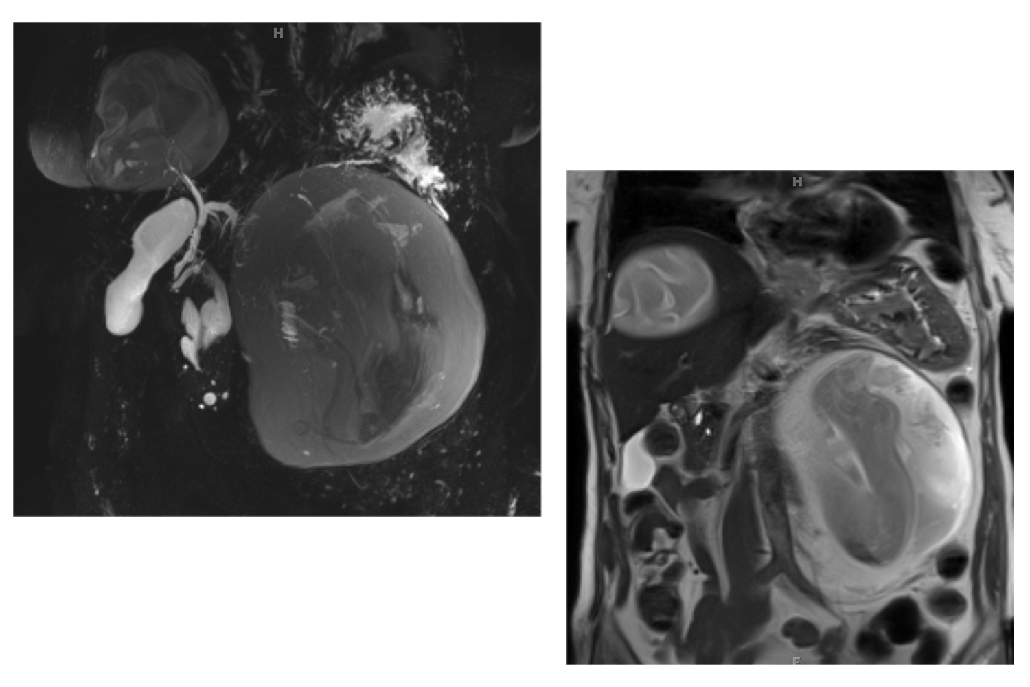 Echinococcal Cyst