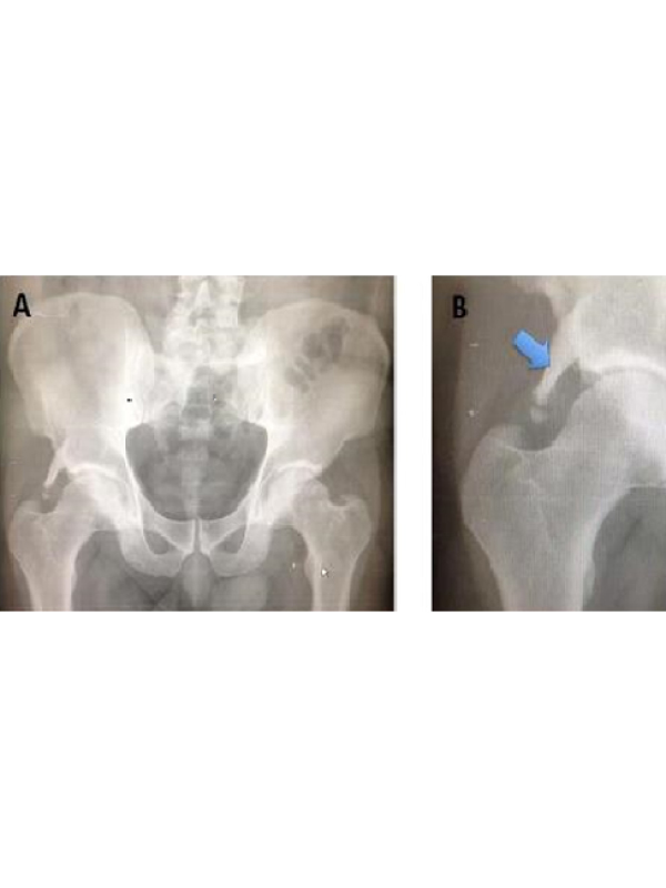 An Asymptomatic Femoroacetabular Impingement: Incidental Finding after Car Crash