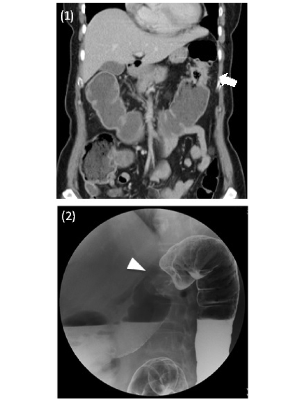 Apple-core Lesion of Colon Adenocarcinoma by Barium Double Contrast Enema