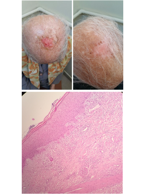 Erozive Pustular Dermatosis of Scalp: An Overlooked Entity