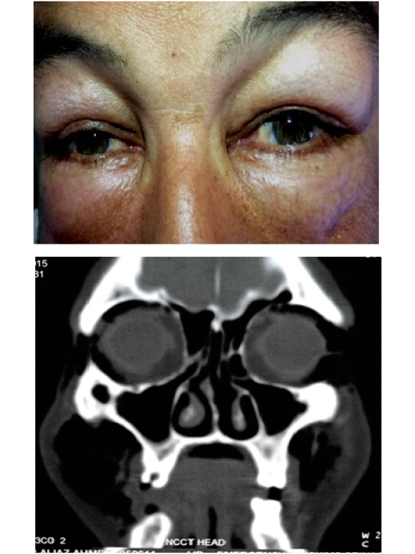 Periorbital Subcutaneous Emphysema