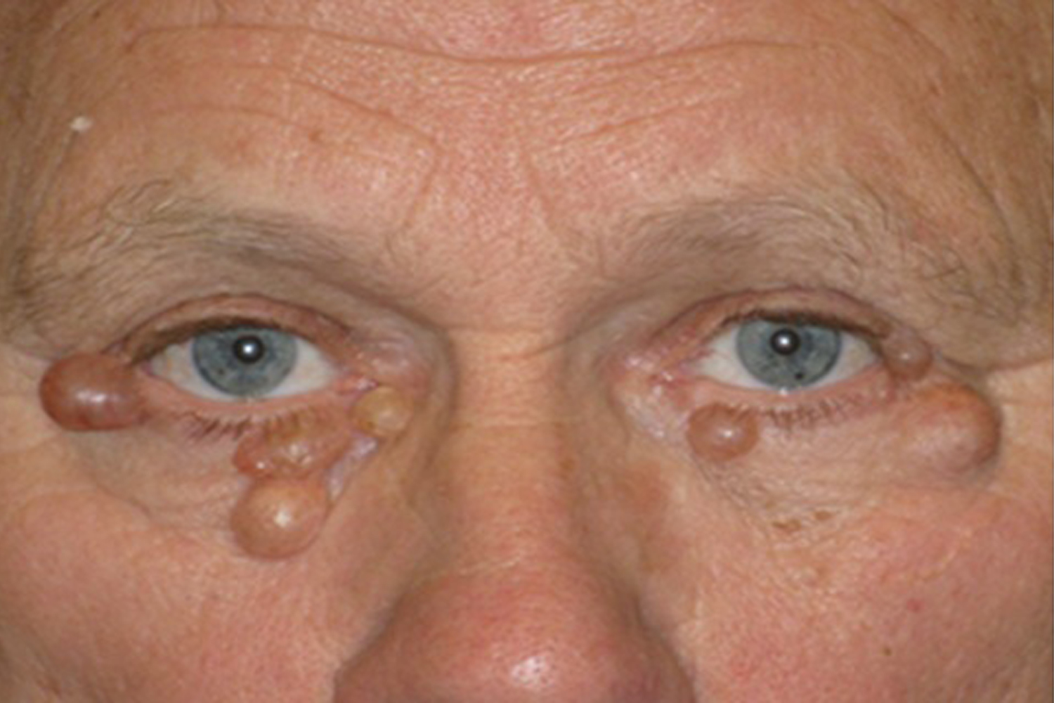 Bilateral Peri-Orbital Skin Lesions