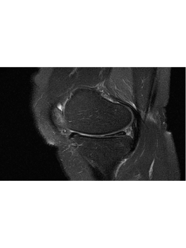 Cost-effectiveness Analysis of the Diagnosis of Meniscus Tears
