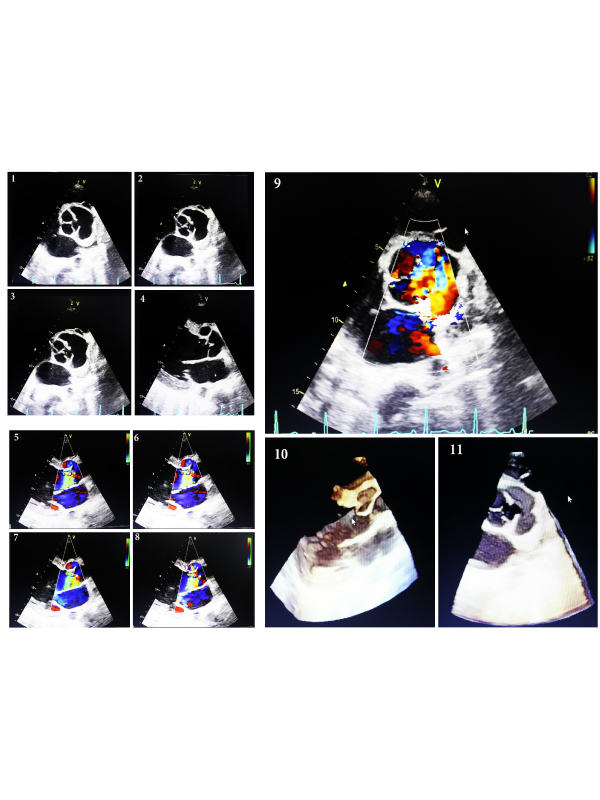 Ruptured Left Sinus of Valsalva into Left Venticle - A Rarity in Cardiology