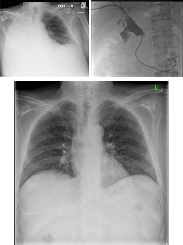 A Miss and a Hit - An Iatrogenic Event