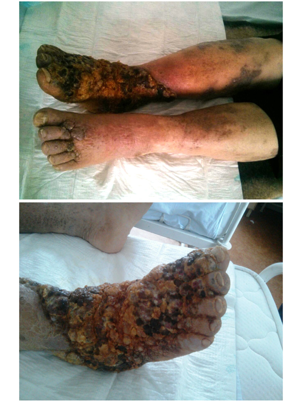 Images of Kaposi Sarcoma - Inferior Limb Skin Lesions: Case Presentation
