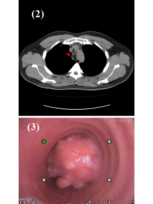 Near Obstructing Tracheal Lipoma