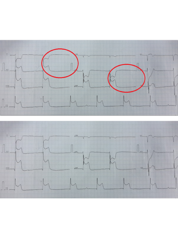 A New ECG Sign