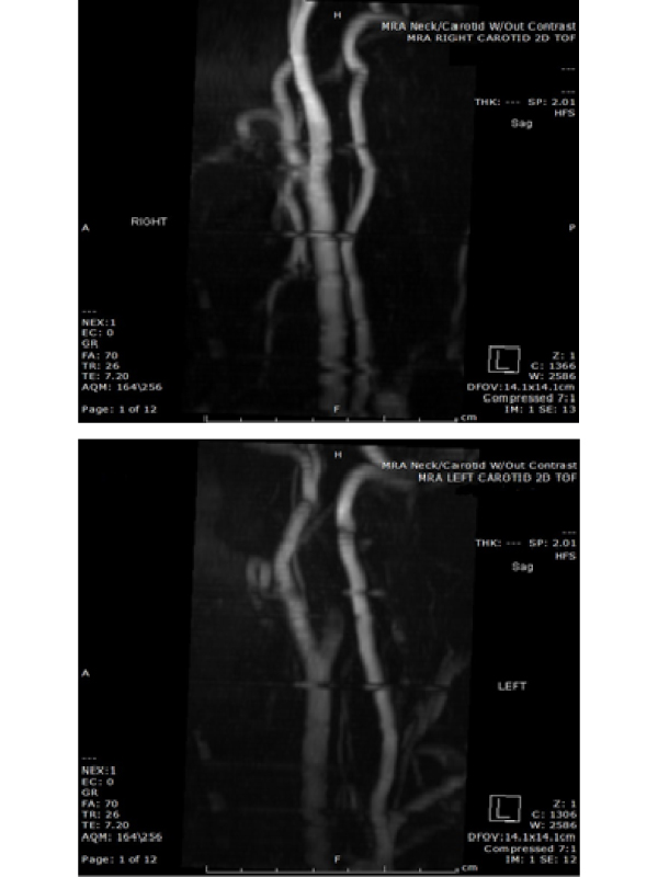 Infective Endocarditis Causing Complete Occlusion of Internal Carotid Artery and Presenting as Acute Ischemic Stroke