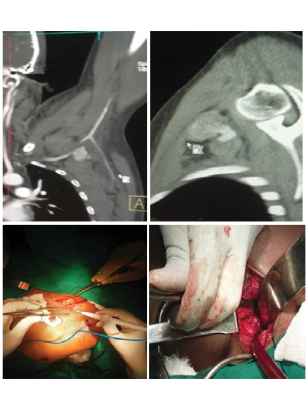 Post Stab Injury Subclavin Artery Pseudoaneurysm Excision