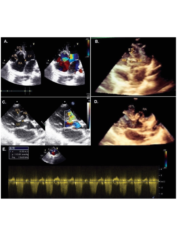 Ebsteinï¿½s Anomaly with Gerbode Defect: A Rare Association