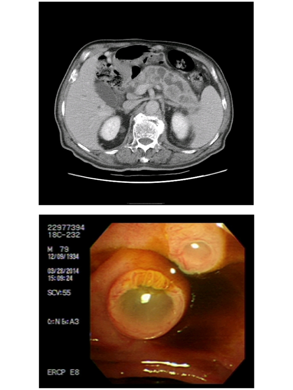 Intraductal Papillary Mucinous Neoplasm (IPMN) of Pancreas in Elderly Patient