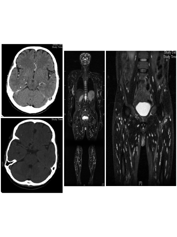 Cysticercosis-A Pictorial Review