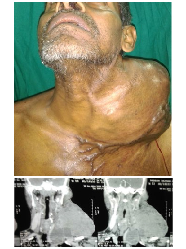 A Rare Presentation of Papillary Thyroid Carcinoma
