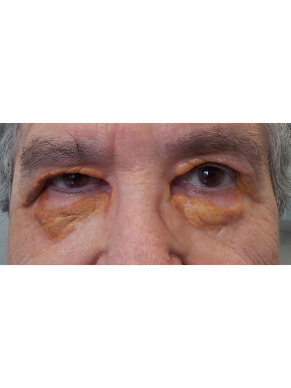 Necrobiotic Xanthogranuloma in a Patient with Multiple Myeloma