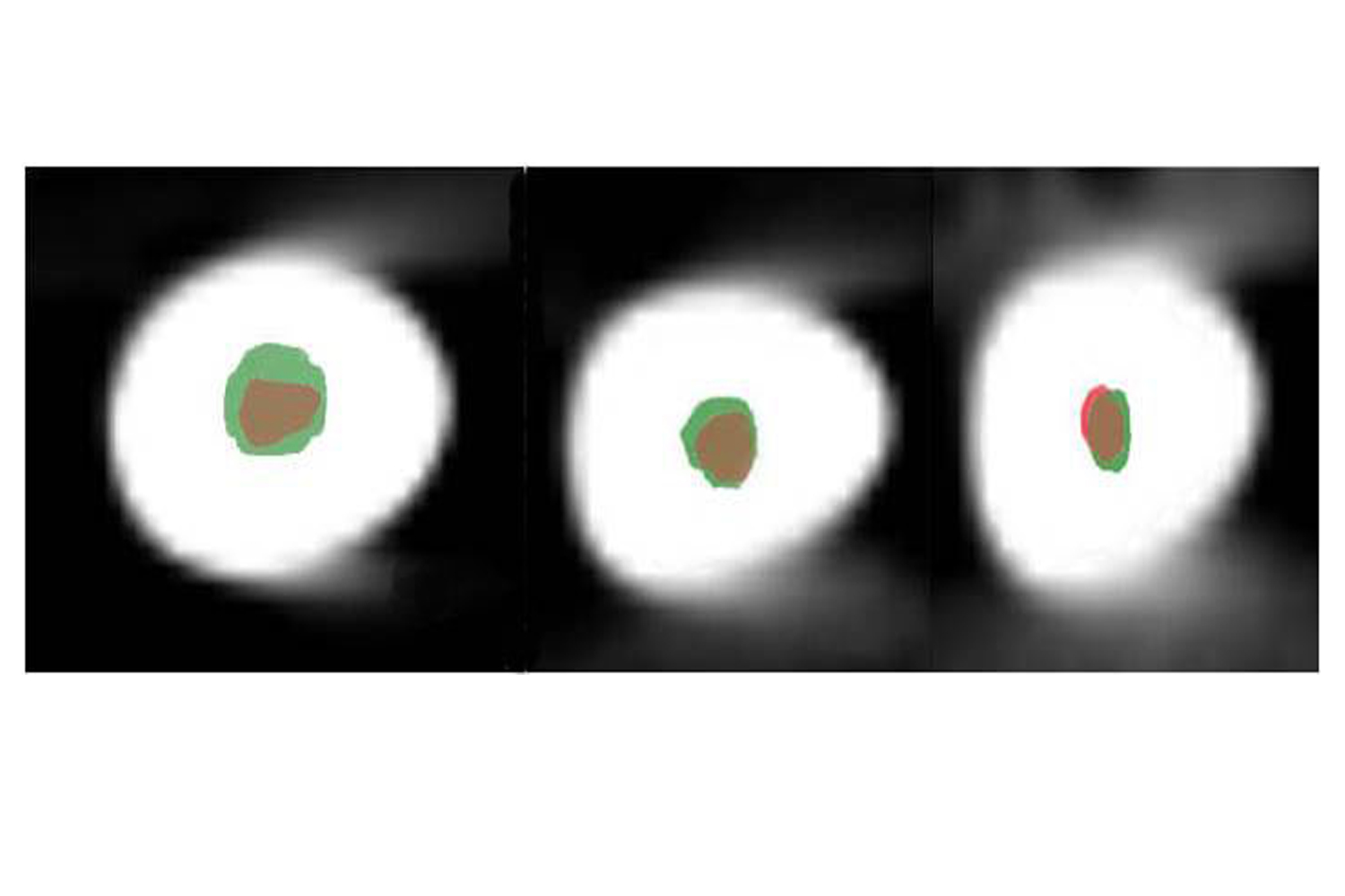 Axial Section of Cone Beam Computed Tomographic Analysis of Root Canal