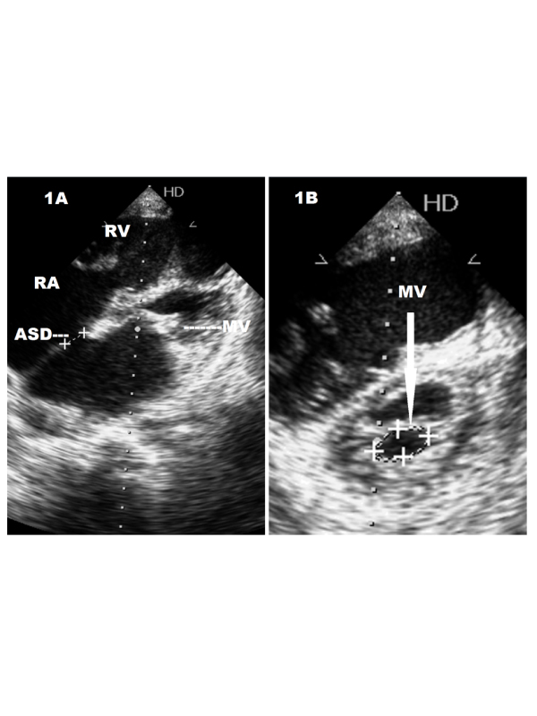 Lutembacherï¿½s Syndrome with Right Heart Failure-echocardiographic Findings
