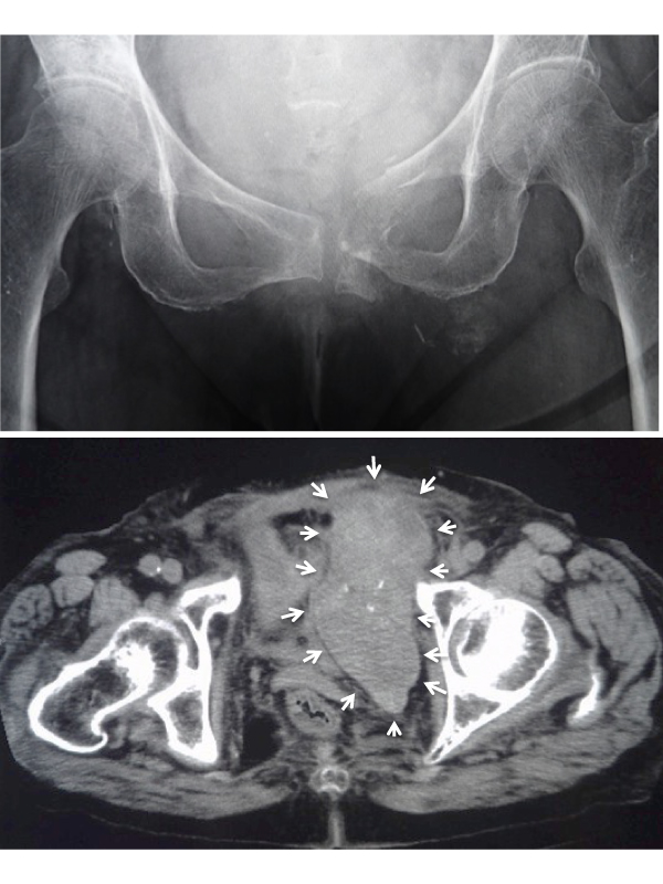 Massive Intrapelvic Hematoma after a Pubic Ramus Fracture in an Osteoporotic Patient