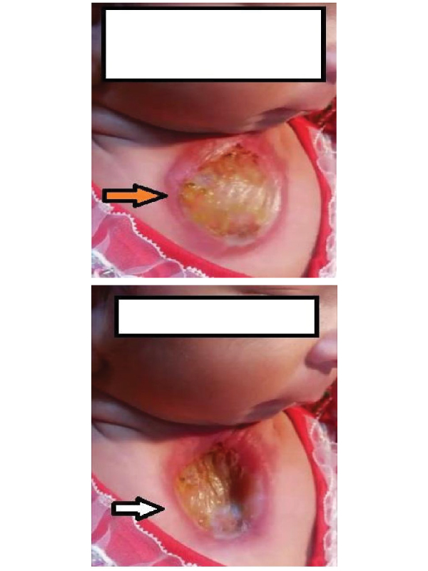 Sternal Cleft ï¿½ A Rare Entity