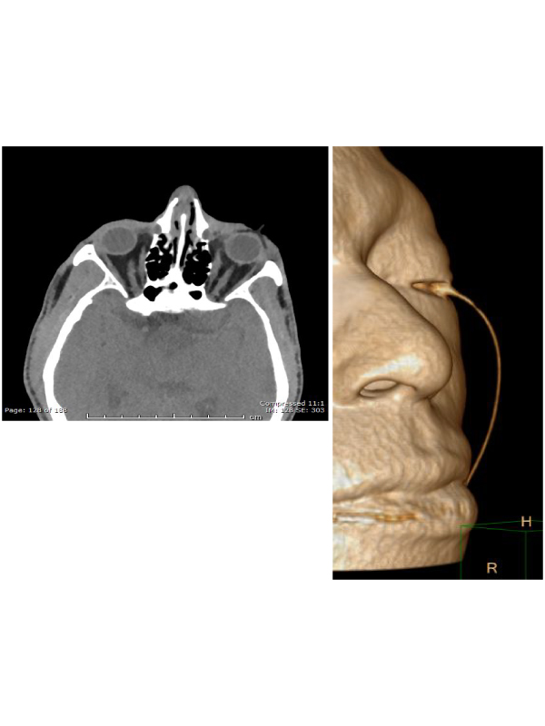 Alkali Chemical Burn with Placement of Morgan Lens
