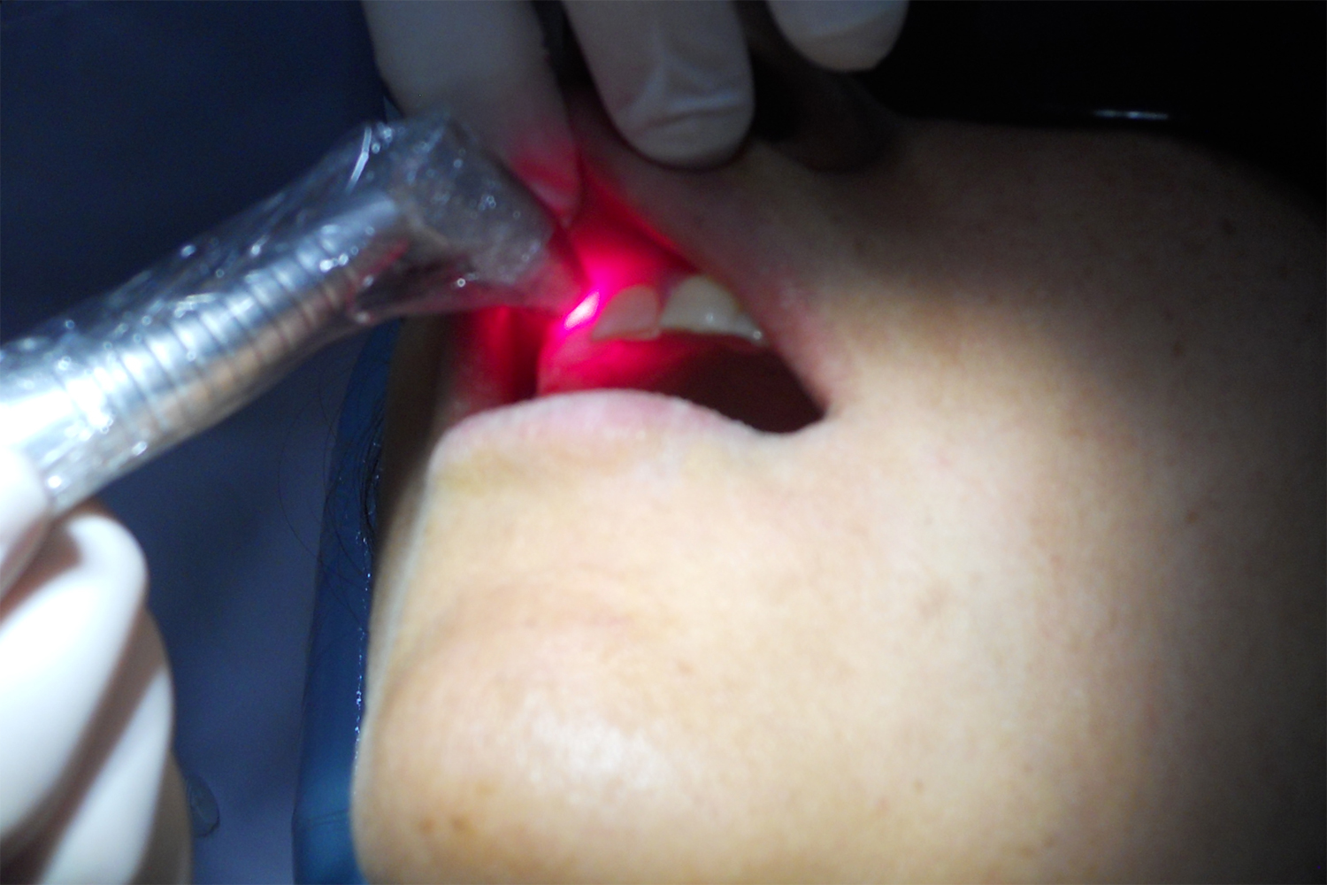 Photodynamic Therapy in Periodontal Disease