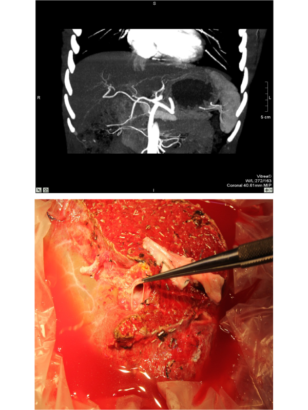 Replaced Right Hepatic Artery Entering the Porta through the Cystic Plate