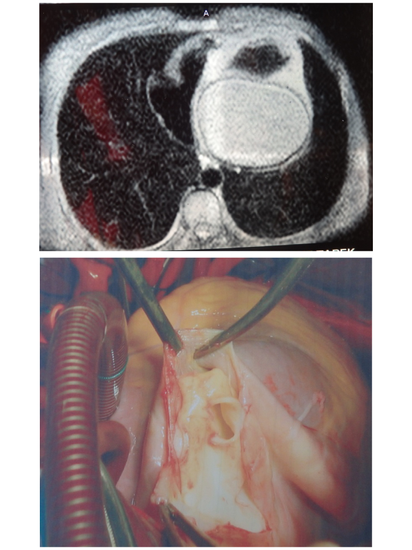 Surgery of a Hydatid Cyst of the Left Ventricle