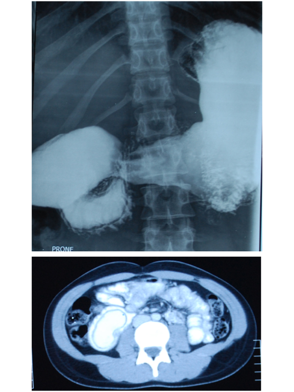 Unusual Cause of Gastric Outlet Obstruction