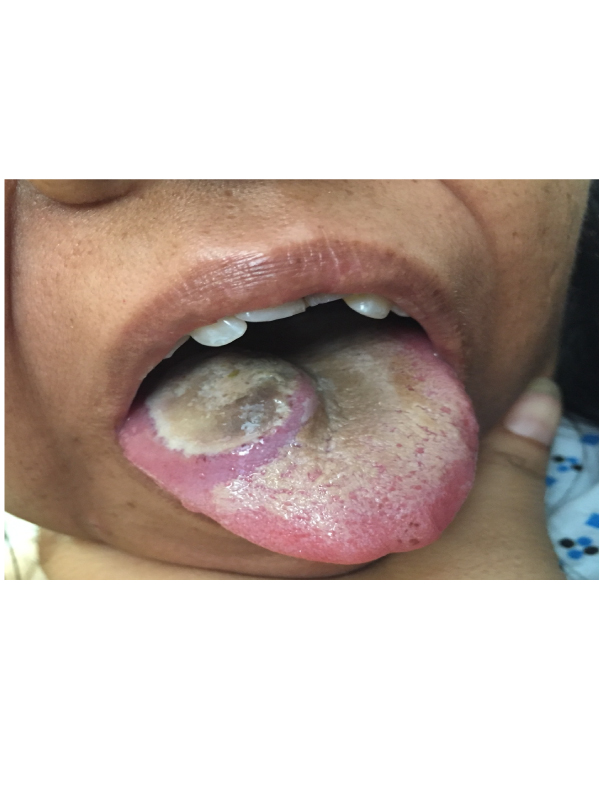 Chloroma of the Tongue in a Patient with Acute Myeloid Leukemia