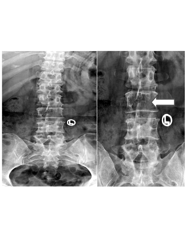 Winking-owl Sign - An Uncommon Presentation of Spine Metastasis