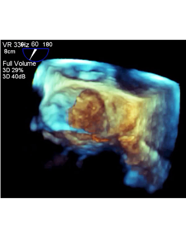 Loose-Flapping Left Atrial Myxoma Fragment Identified on 3D- Echocardiography