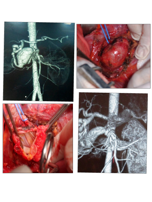 Surgical Management of a Superior Mesenteric Artery Aneurysm Resulting from Neurofibromatosis Type I