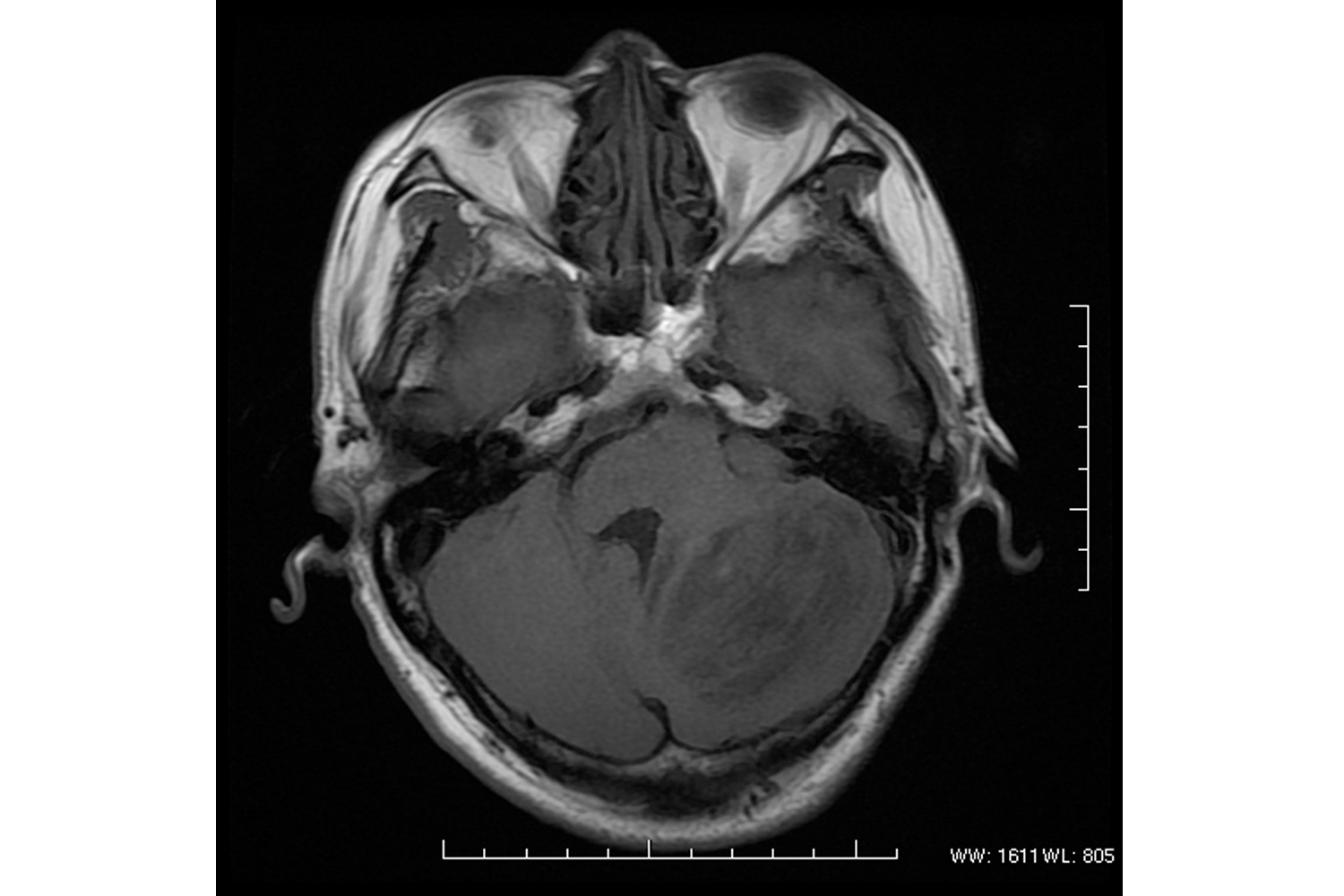 Assessment with MR Imaging 