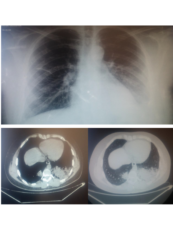 A Case of Chemical Pneumonia Due to Paint Thinner Exposure