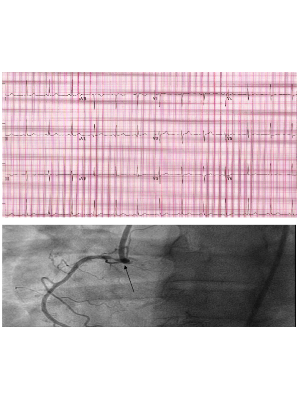 Variant Angina