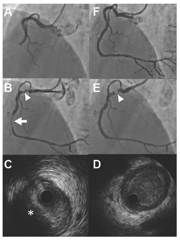 Different Intravascular Ultrasonograms Obtained from the Site of an Accordion Phenomenon before and after Distal Stenting