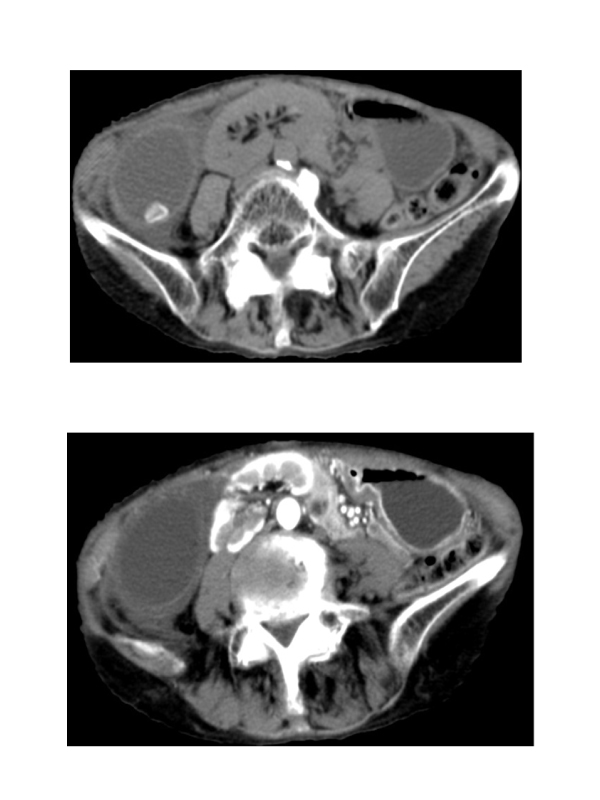 Torsion of the Gallbladder